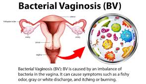 Bacterial Vaginosis (BV): Symptoms, Treatment, and Prevention