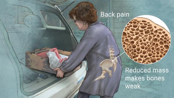 Unmasking the Silent Thief: Osteoporosis in Women and How to Fight Back